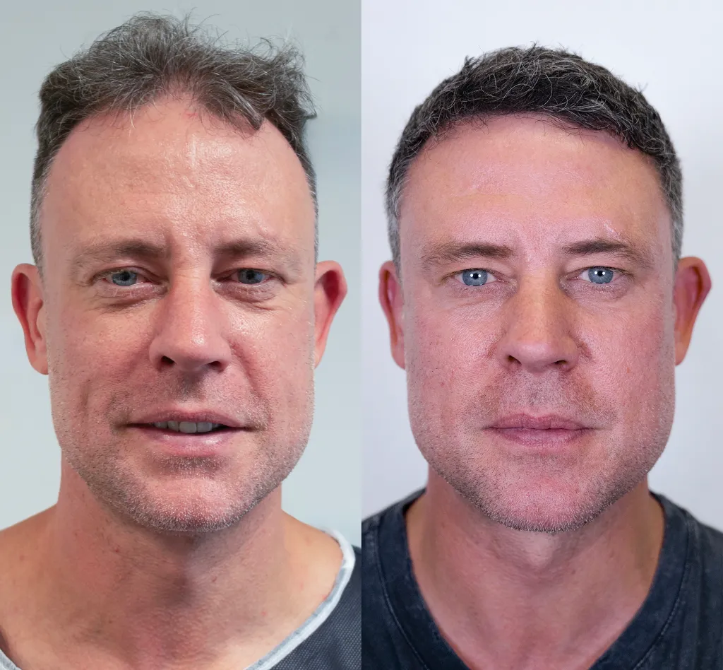 Antes e depois do protocolo capilar — caso 3
