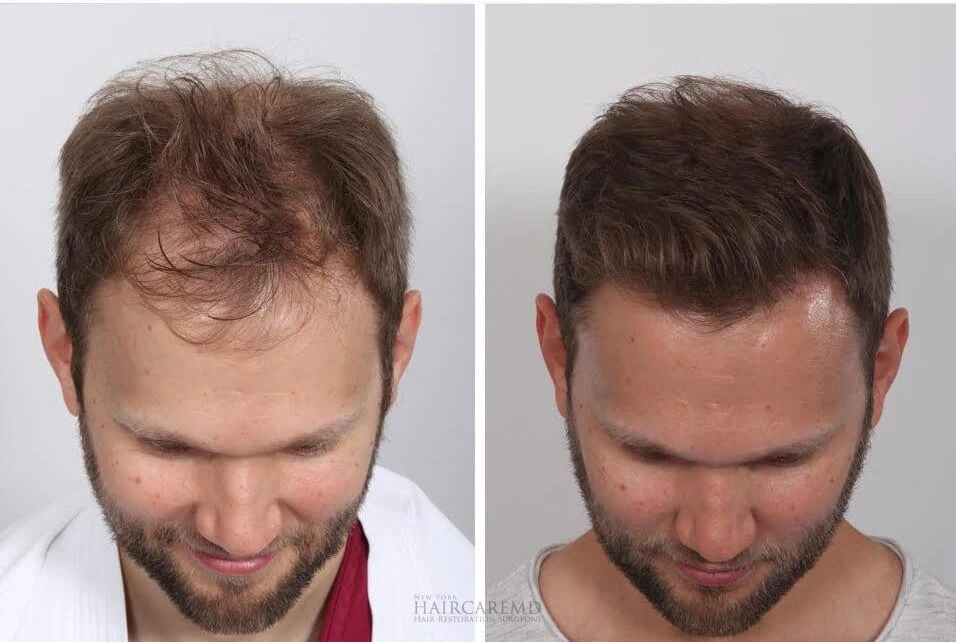 Antes e depois do protocolo capilar — caso 2