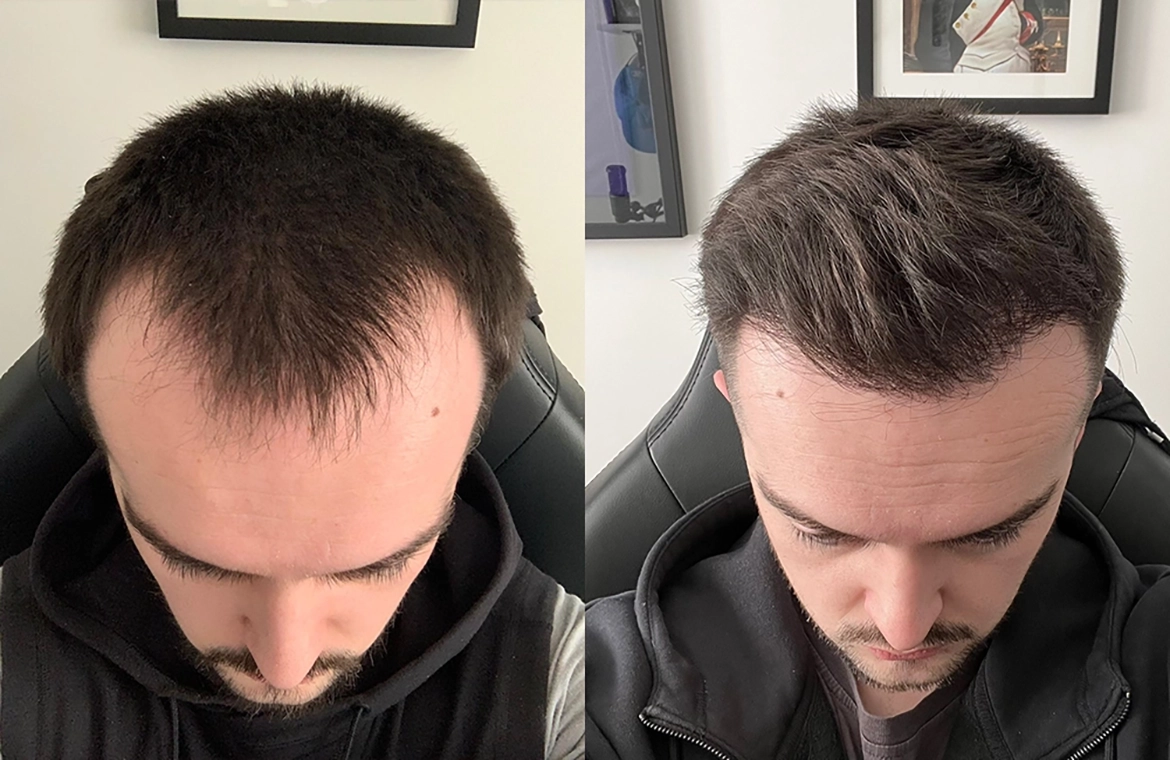 Antes e depois do protocolo capilar — caso 1